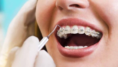 Braket Çeşitleri Ve Diş Teli Tedavisi