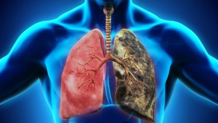 Akciğer Kanseri Nedir, Neden Olur?