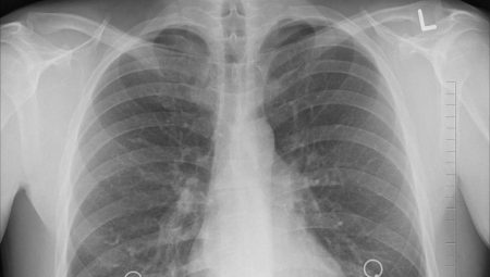 Akciğer Kanseri Belirtileri Nelerdir?