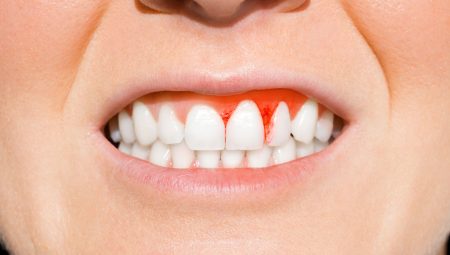 Diş Eti İltihabı ve Periodontit Tedavisi