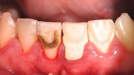Diş Taşı Nedir Nasıl Temizlenir