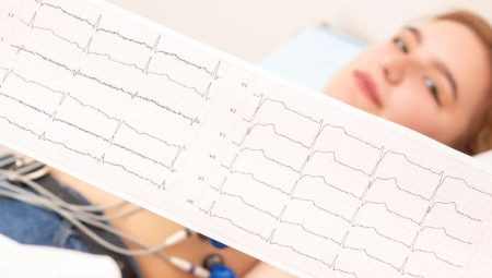 Elektrokardiyografi (EKG) Nedir?