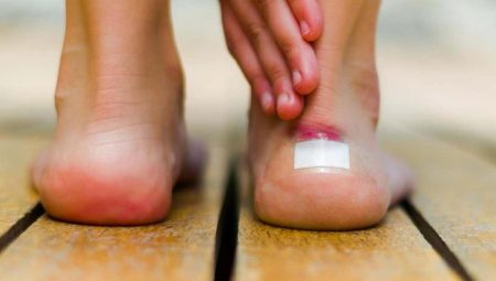 Ayakkabı vurması sonrasında oluşan yara nasıl hızlı iyileşir? Ayakkabı vurmasına ne iyi gelir?